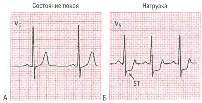 Как происходит ЭКГ обследование