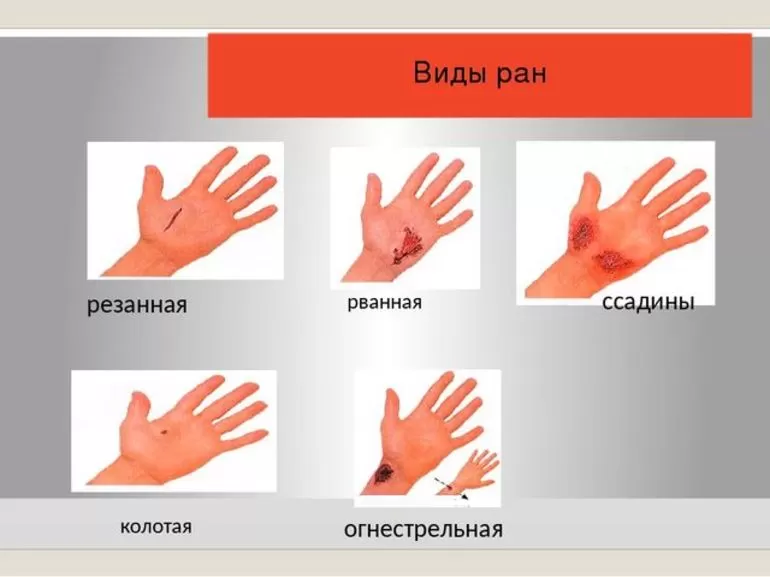 классификация ран по характеру повреждения